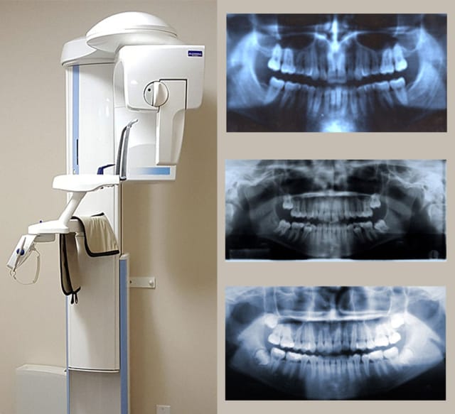 Digital Panoramic X-Rays